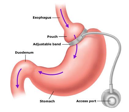 What Are The Gastric Banding Complications
